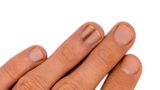 Перелік ознак на ваших нігтях, які потребують консультації дерматолога