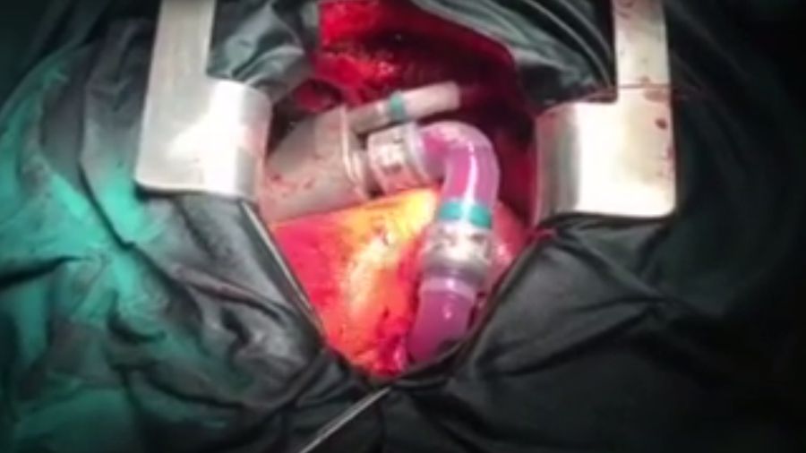 В Україні вдруге успішно пересадили механічне серце