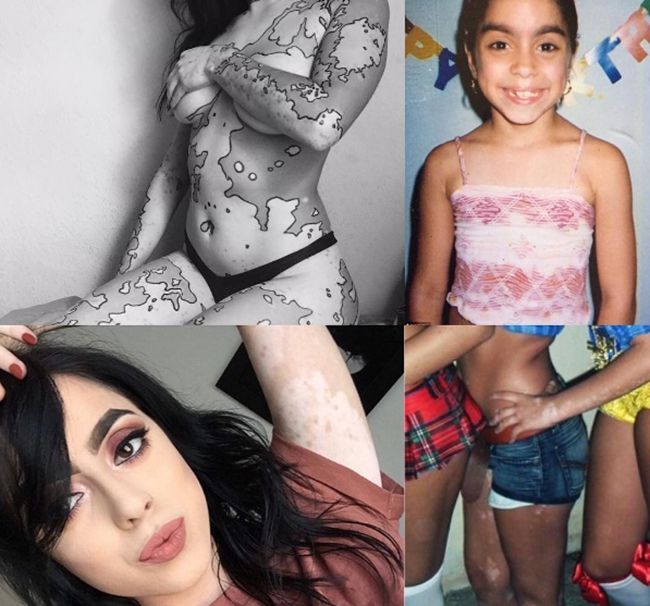 Дівчина перетворила свою хворобу на витвір мистецтва: ефектні фото - фото 1