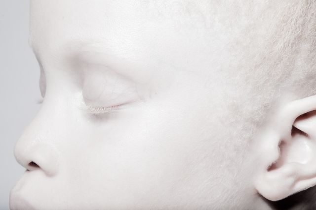 Унікальна особливість зовнішності цих близнят підкорила світ: вражаючі фото - фото 157151