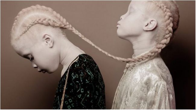 Унікальна особливість зовнішності цих близнят підкорила світ: вражаючі фото