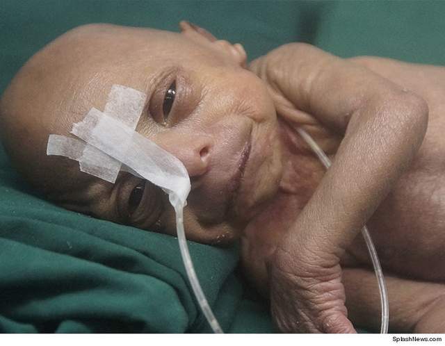 У Бангладеші народився справжній "Бенджамін Баттон": фото унікального малюка - фото 169861