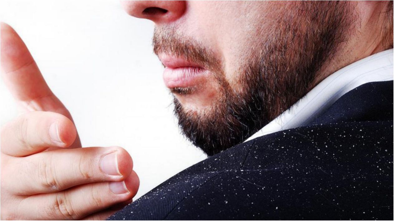 Як позбутися лупи раз і назавжди