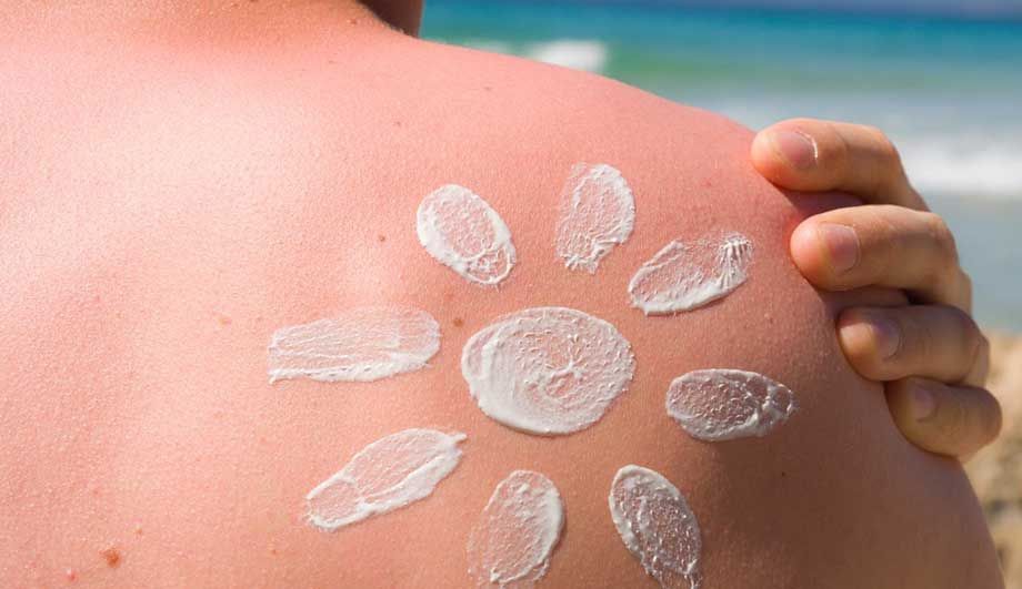 Чим лікувати сонячні опіки в домашніх умовах