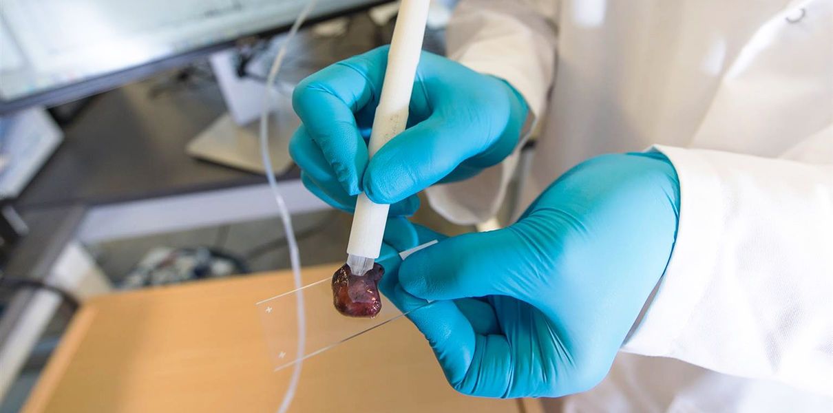 Створено ручку-спектрометр, яка діагностує рак за 10 секунд