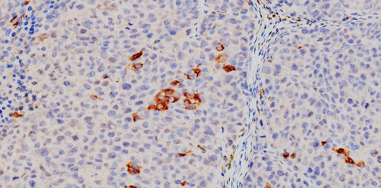 Створена вакцина проти раку печінки