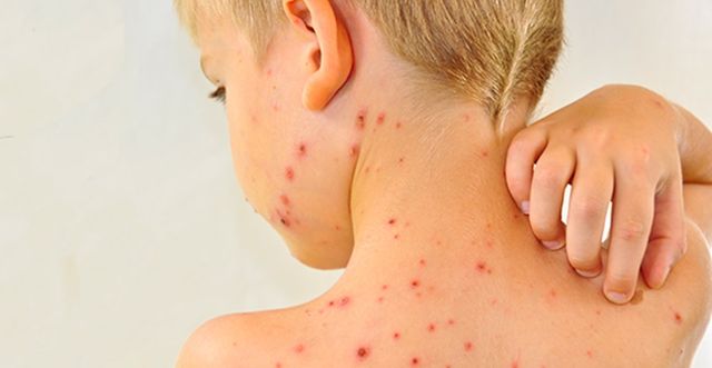 Кір у дітей - фото 219940