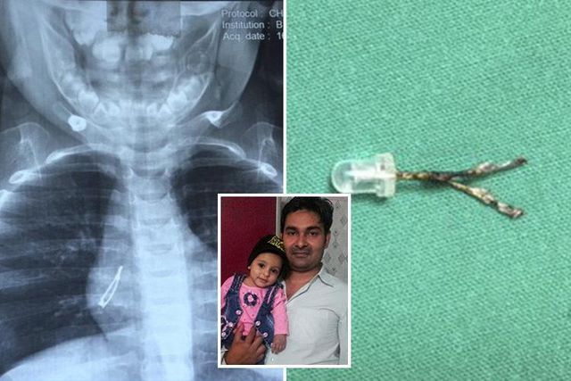 У легенях індіанки виявили лампочку - фото 223723