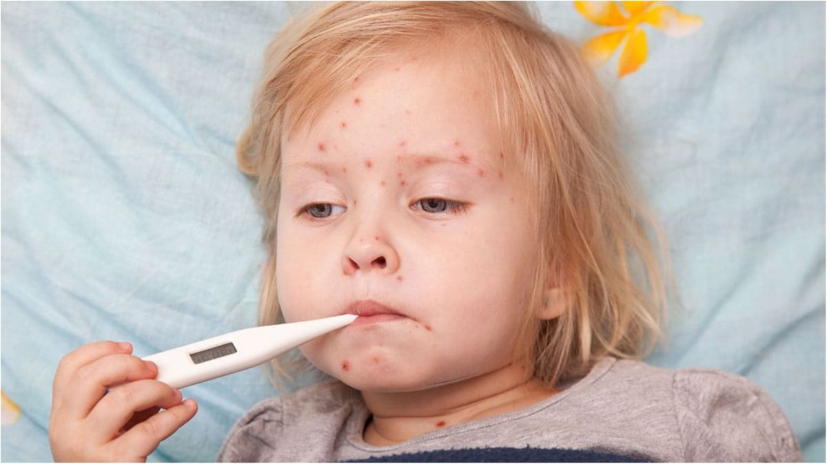 Кір у дітей та дорослих: симптоми, лікування і профілактика кору