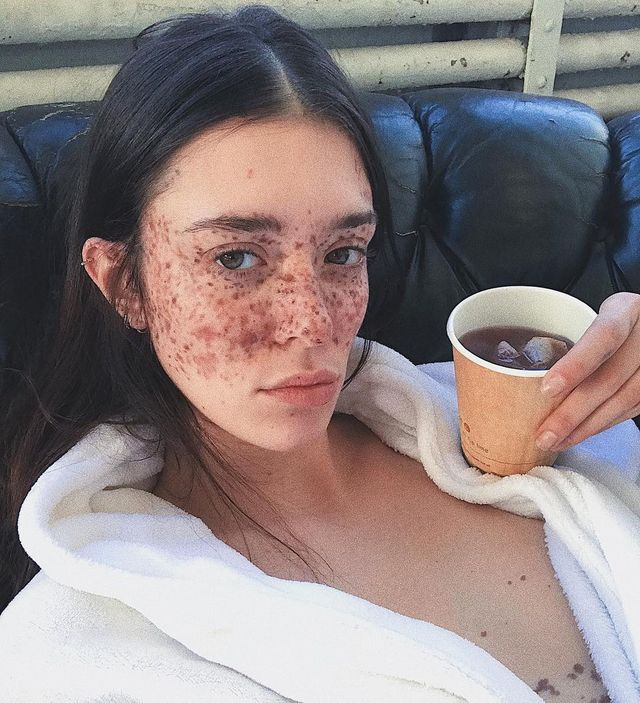Модель з незвичайними веснянками підкорила Instagram- фото 228939