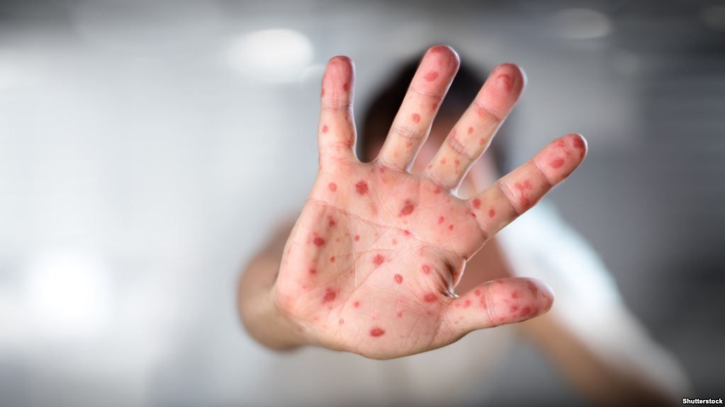 Кір в Україні: у МОЗ прокоментували ситуацію - фото 1