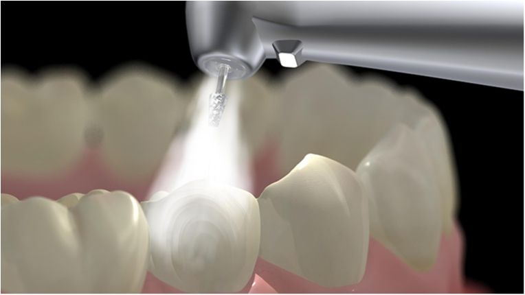 Вчені створили вічні пломби для зубів