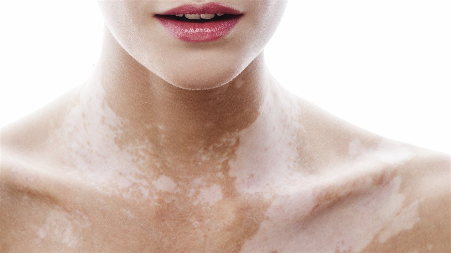 Невиліковно хвора італійка стала знаменитою ню-моделлю (18+) - фото 1