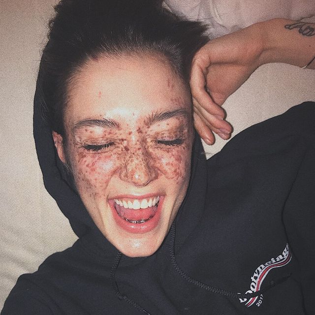 Модель з незвичайними веснянками підкорила Instagram- фото 228940