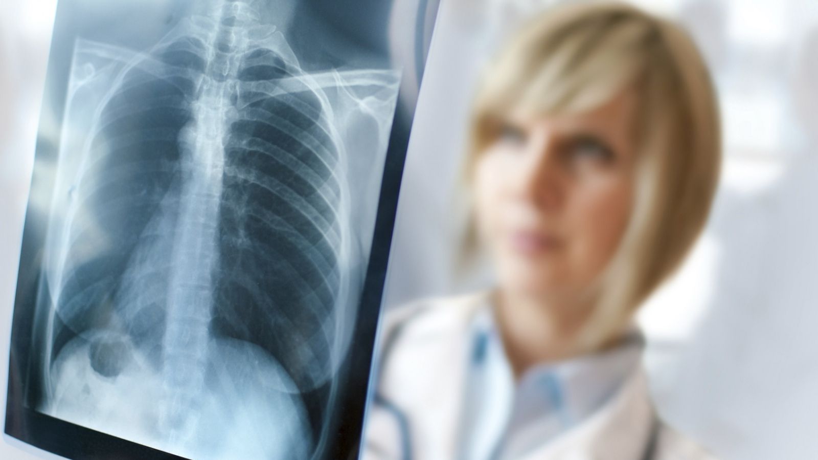 Флюорографія не є ефективною для запобігання туберкульозу - фото 1