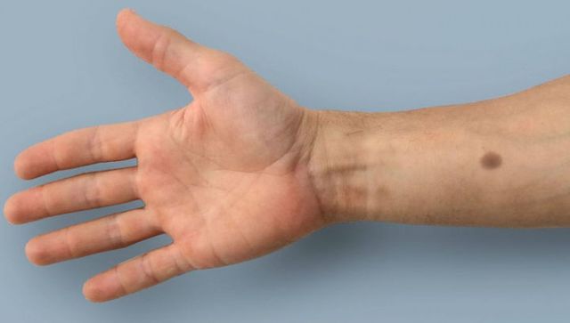 Вчені створили татуювання для раннього виявлення раку - фото 242300