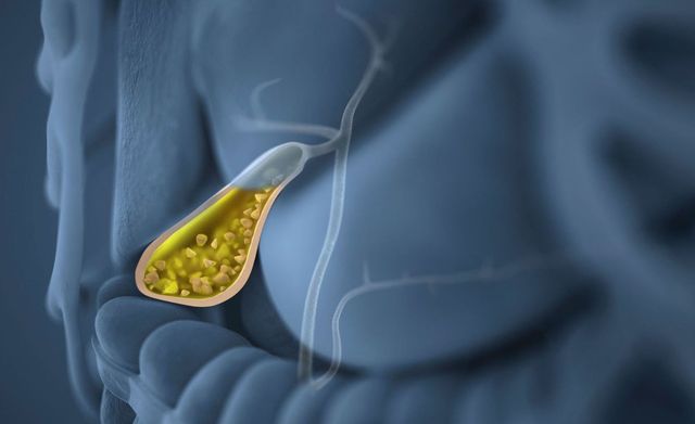 Ось що стає причиною появи жовчних каменів - фото 256362