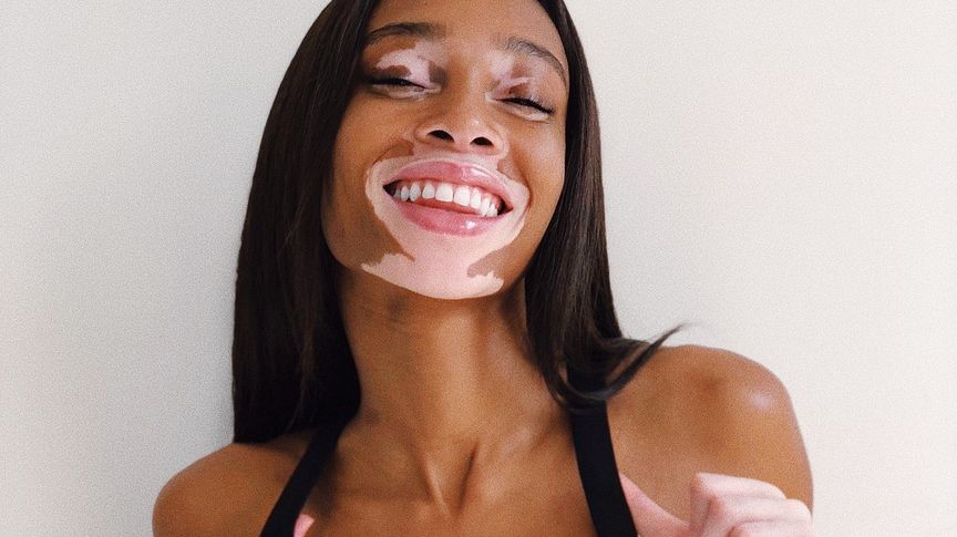 Модель з рідкісною хворобою стала ангелом Victoria's Secret