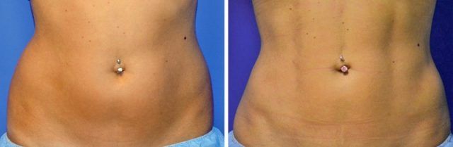 Хірурги навчилися перетворювати жир на кубики пресу - фото 324499