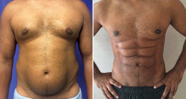 Хірурги навчилися перетворювати жир на кубики пресу - фото 324500