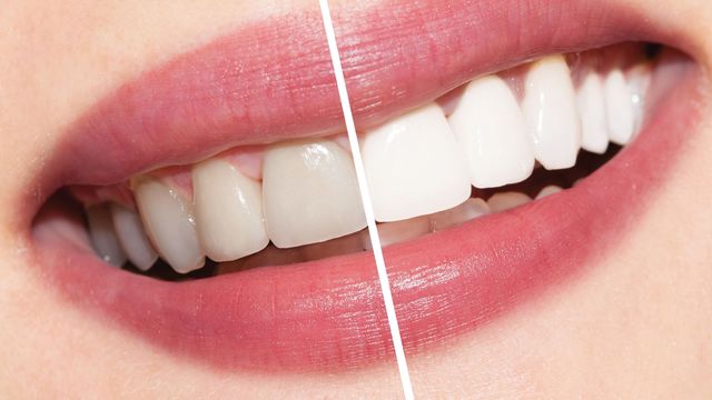 Відбілити зуби вдома дуже просто- фото 327495