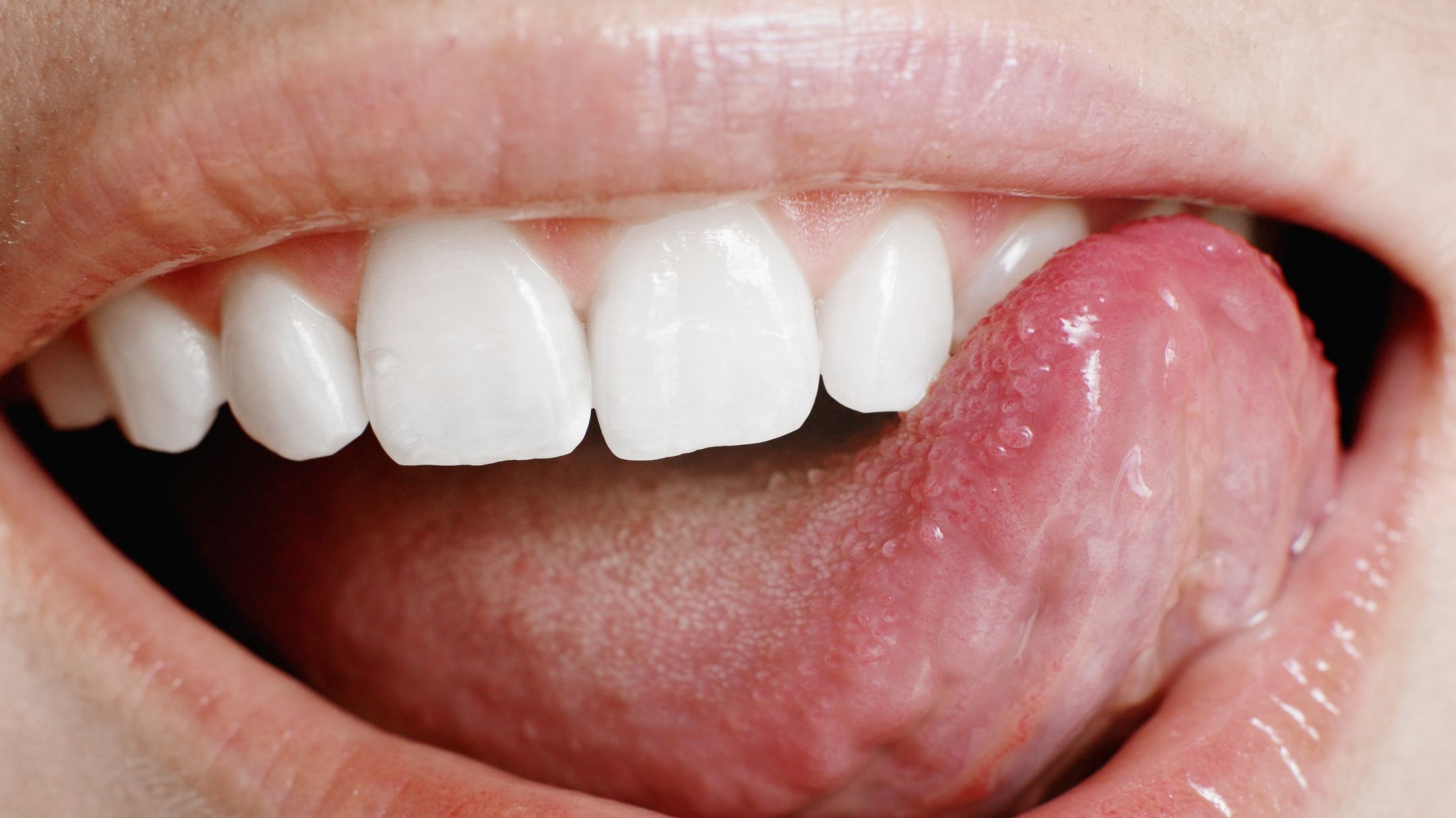 Як лікувати виразки на язиці вдома - фото 1