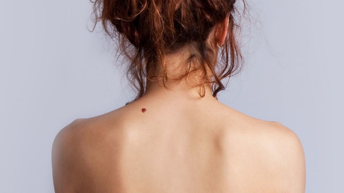 Чому у нас з'являються нові родимки: відповідь вчених