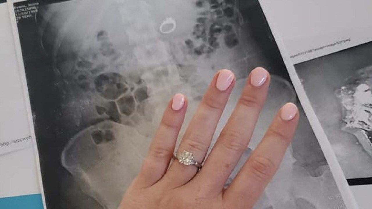 Дівчина з'їла свій перстень уві сні: її переслідували грабіжники