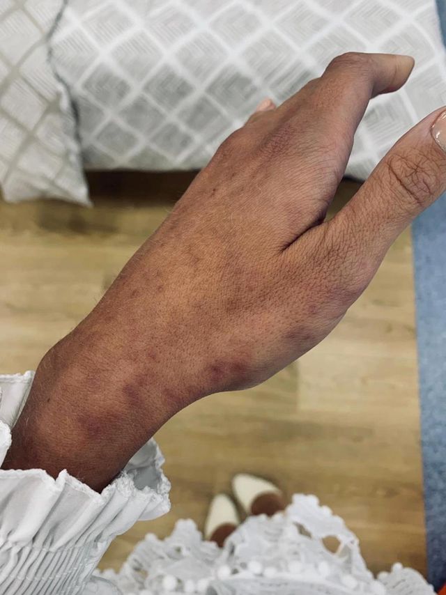 Учасниця проєкту про виживання показала наслідки шоу: фото не для слабкодухих - фото 360284