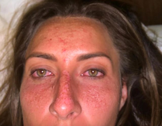 Учасниця проєкту про виживання показала наслідки шоу: фото не для слабкодухих - фото 360285