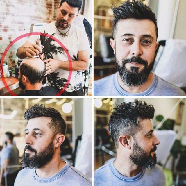 До і після: лисі чоловіки відвідали процедуру заміщення волосся - фото 361092