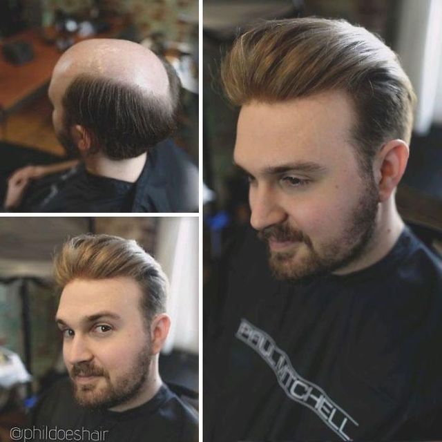 До і після: лисі чоловіки відвідали процедуру заміщення волосся - фото 361096