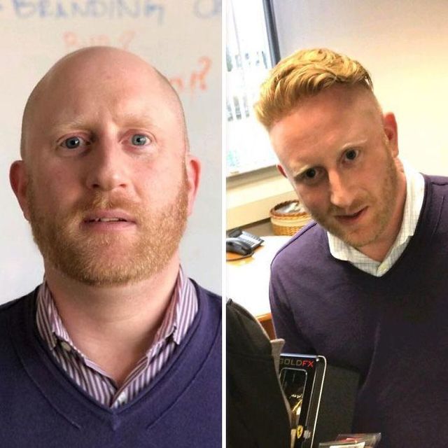 До і після: лисі чоловіки відвідали процедуру заміщення волосся - фото 361104