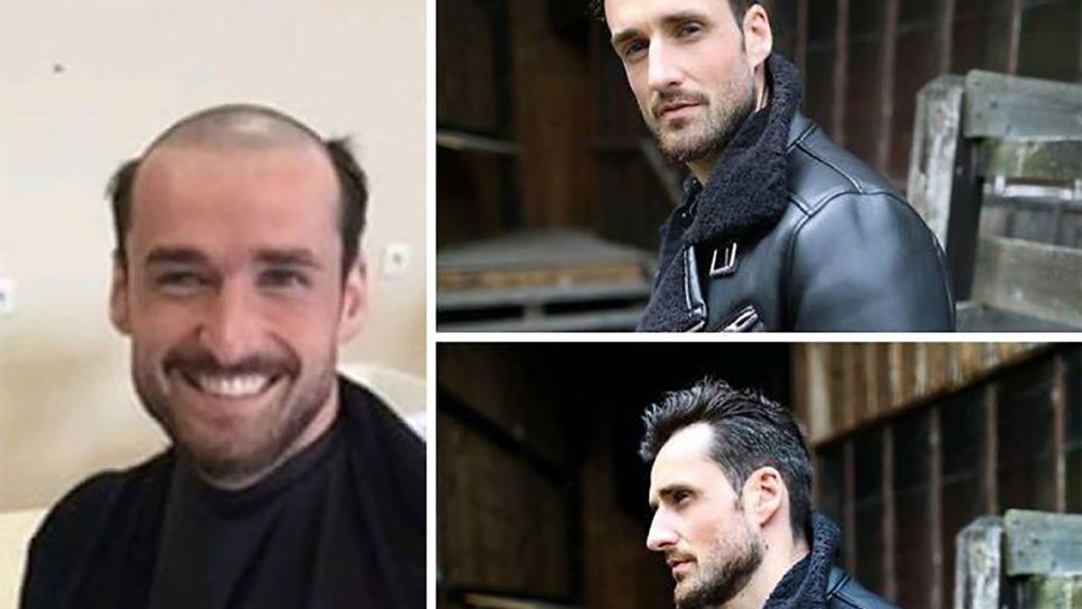 До і після: лисі чоловіки відвідали процедуру заміщення волосся