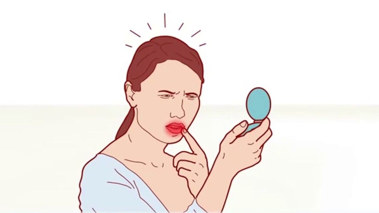 Чому "застуда на губах" нікуди не зникає: пояснення лікарів