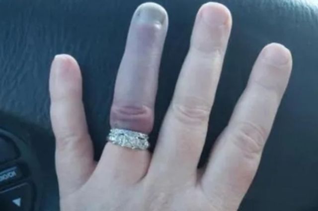 Почорнілий безіменний палець нареченої налякав мережу - фото 369131