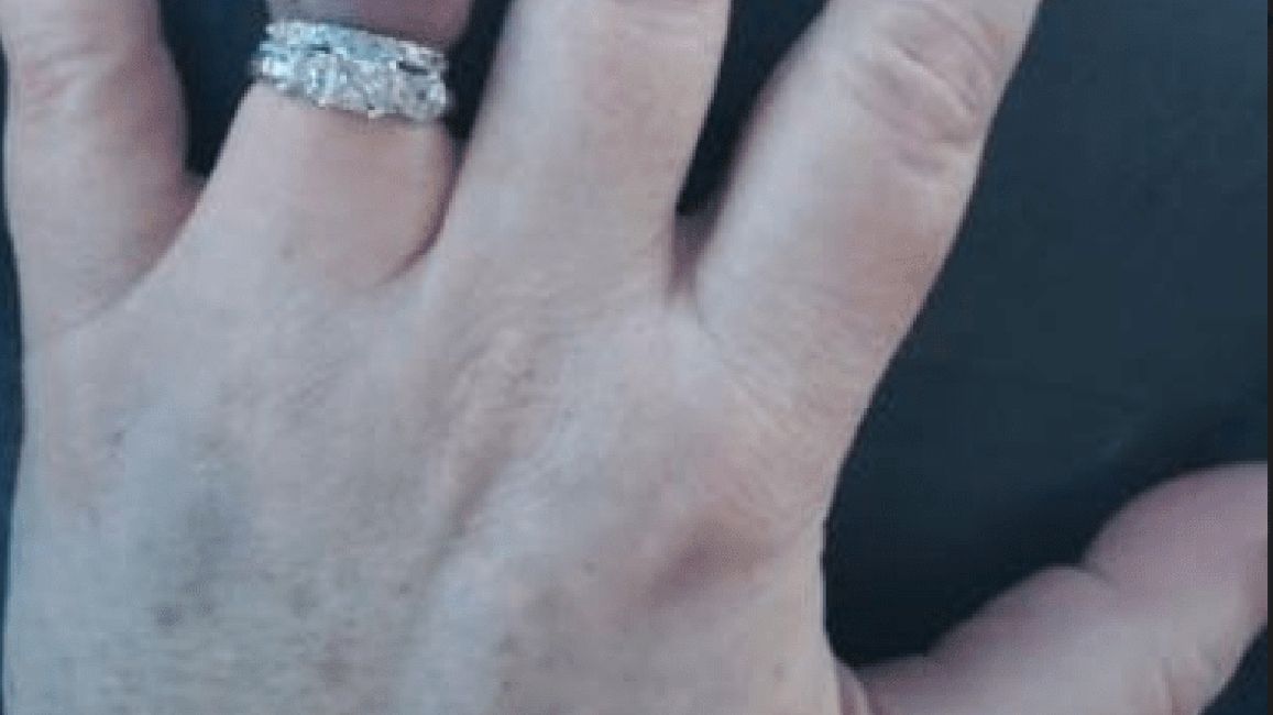 Почорнілий безіменний палець нареченої налякав мережу