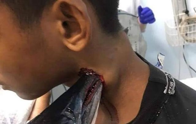 Риба стрибнула в човен і наскрізь проткнула рибалці шию: фотофакт - фото 381986