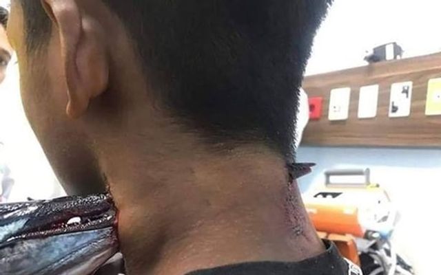 Риба стрибнула в човен і наскрізь проткнула рибалці шию: фотофакт - фото 381987