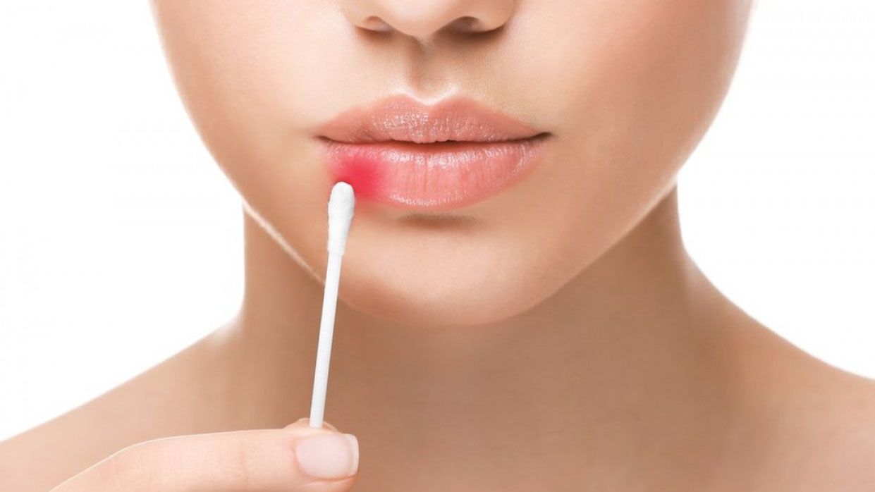 Генетики встановили "батьківщину" і час появи герпесу