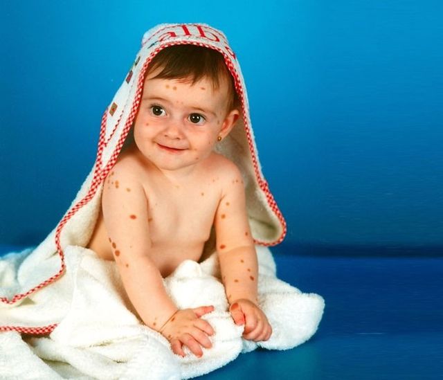 Дівчинка, яку дражнили однолітки через родимки, виросла і стала моделлю - фото 390550