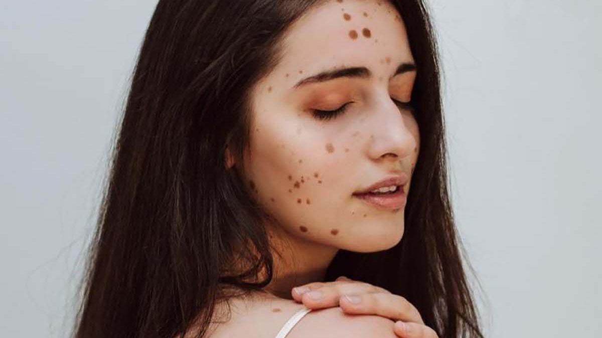 Дівчинка, яку дражнили однолітки через родимки, виросла і стала моделлю