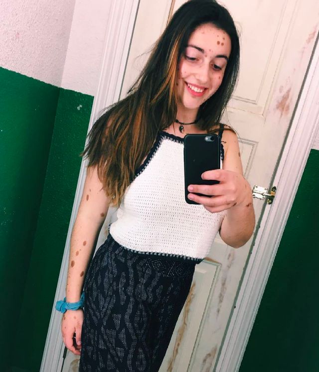 Дівчинка, яку дражнили однолітки через родимки, виросла і стала моделлю - фото 390555