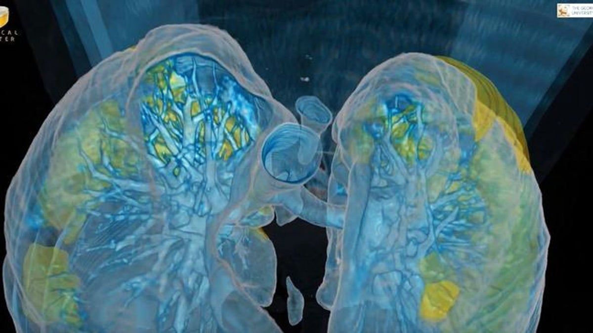 На відео показали, як коронавірус вражає легені