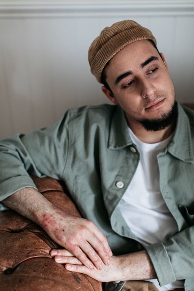 Моделі з дефектами шкіри знялися для реклами - фото 396654