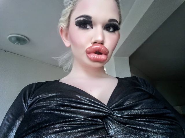 Дівчина зробила собі найбільші губи у світі: фотофакт - фото 402280