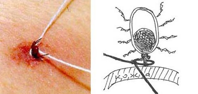 Що робити, якщо вкусив кліщ: як витягнути його в домашніх умовах - фото 403241