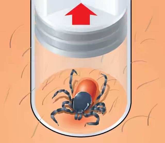 Що робити, якщо вкусив кліщ: як витягнути його в домашніх умовах - фото 403242