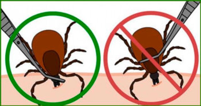 Що робити, якщо вкусив кліщ: як витягнути його в домашніх умовах - фото 403243