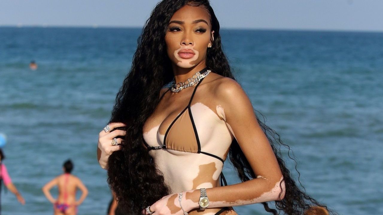 Найвідоміша модель з вітиліго позувала у бікіні